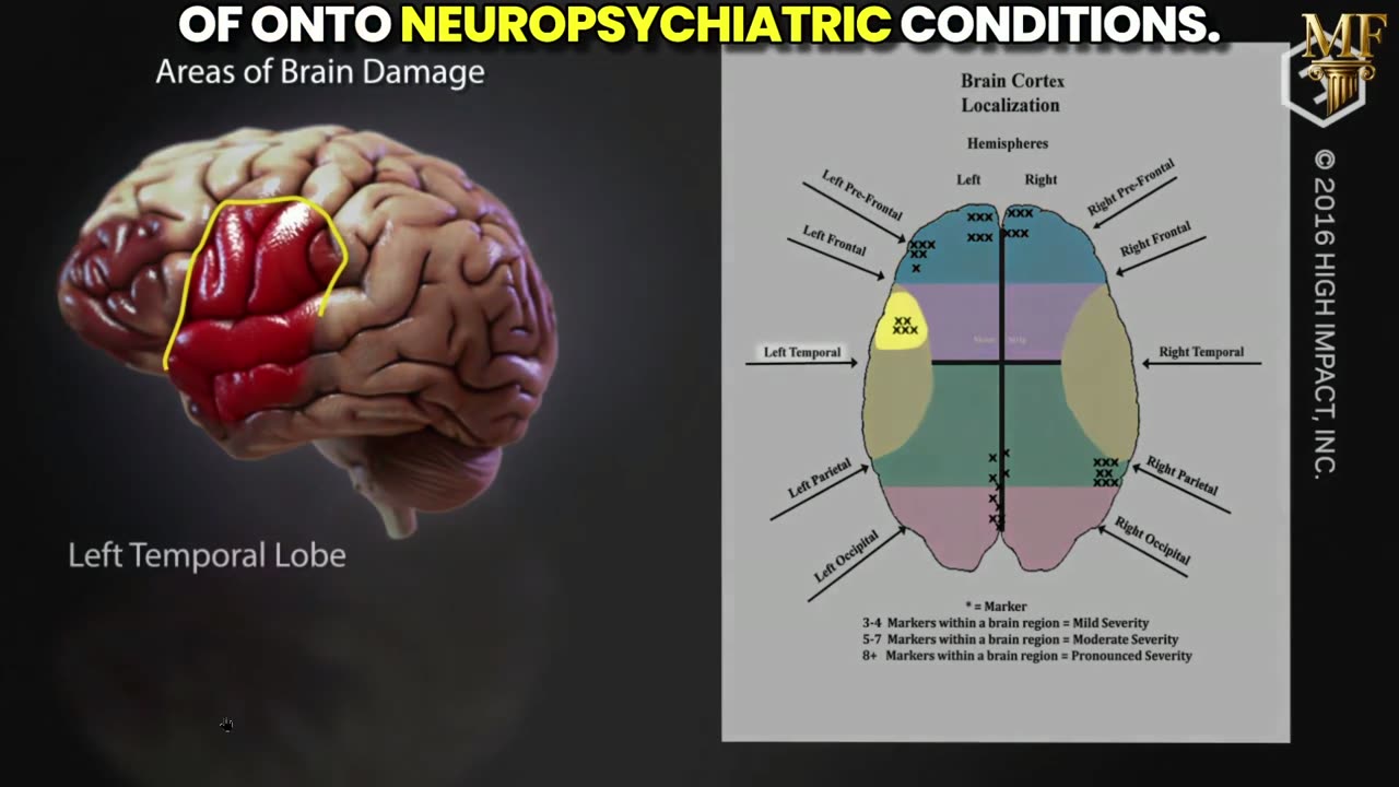 mRNA "vaccines" function as chemical lobotomies. Causing SEVERE brain damage