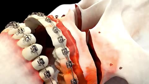 Hammertoe Repair Surgery 3D Animation