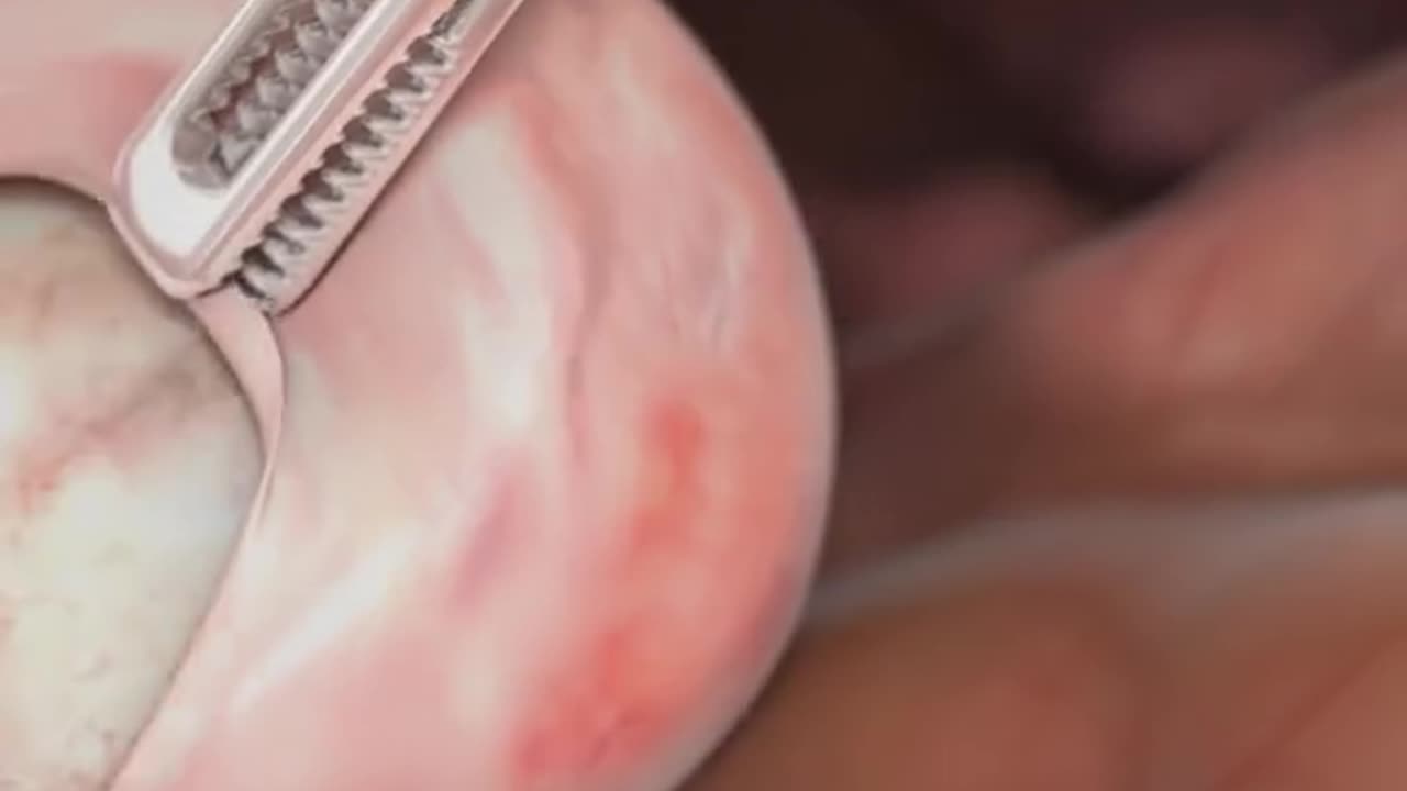 Laparoscopic Laser Procedure For Treatment of conditions such as endometriotic