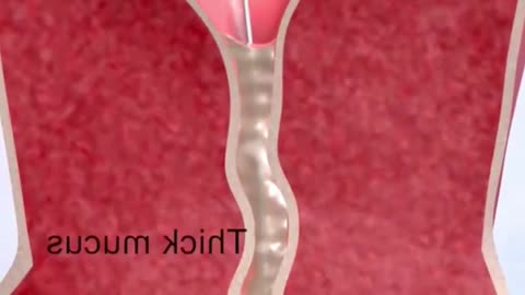 Intrauterine Device (IUDs) For Birth Control