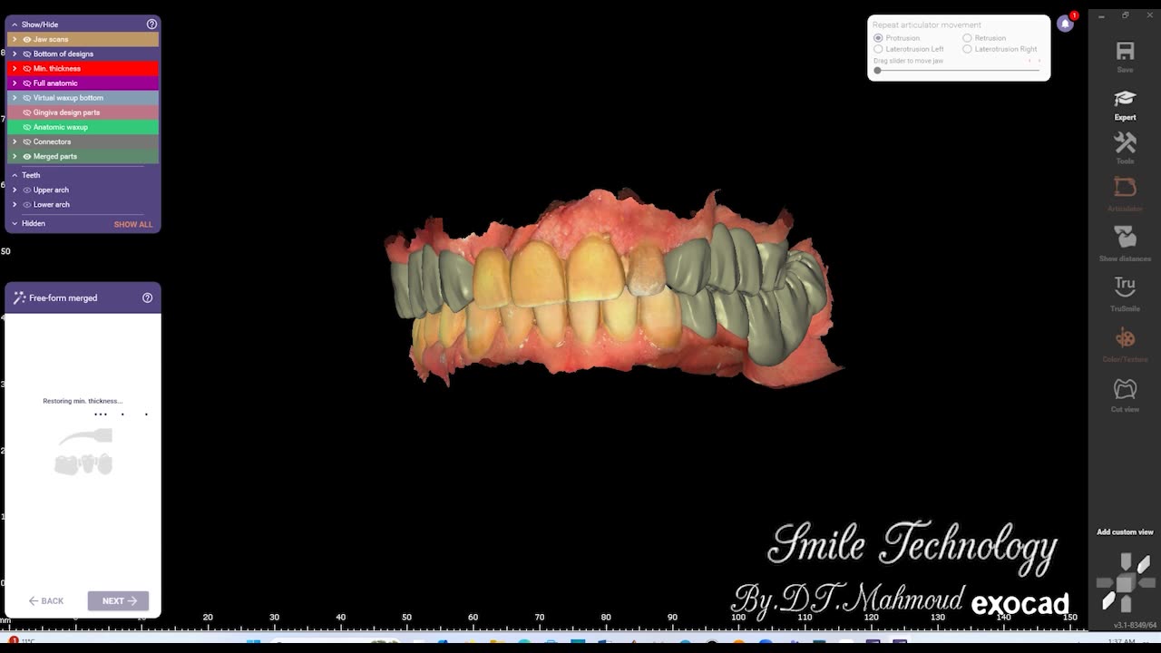 #design #naildesign #dental #dentaldesign #exocadexpert