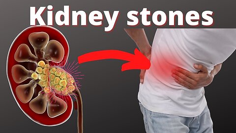 How To Get Rid of Kidney stones