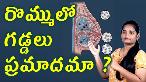 రొమ్ములో గడ్డలు ప్రమాదమా Causes & Risk Factors Breast Mass | Fibroadenoma Homeopathy Treatment Cure