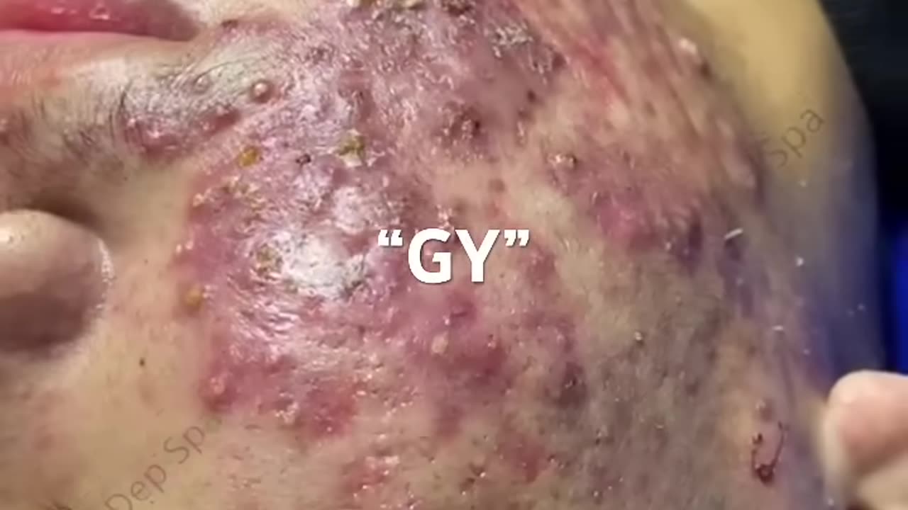 Feedback “GY” #blackhead #sacdepspa
