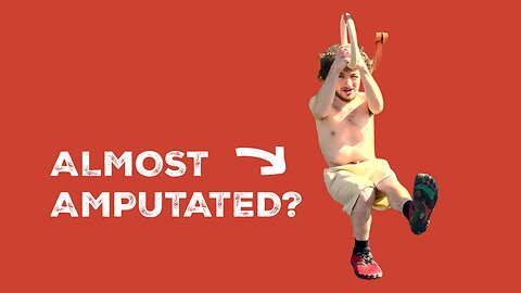 I Asked My Doctor To Amputate My Leg - That’s What Repeating Fractures Did To Me