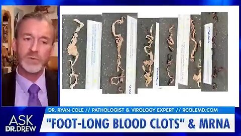 foot long clots removed from mRNA vaccine victims