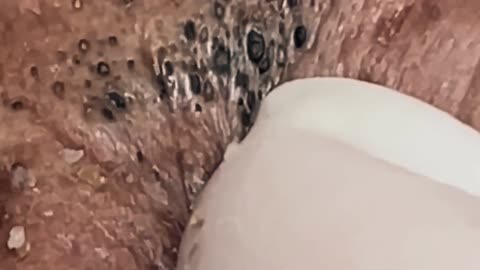 New satisfying blackhead removal #6