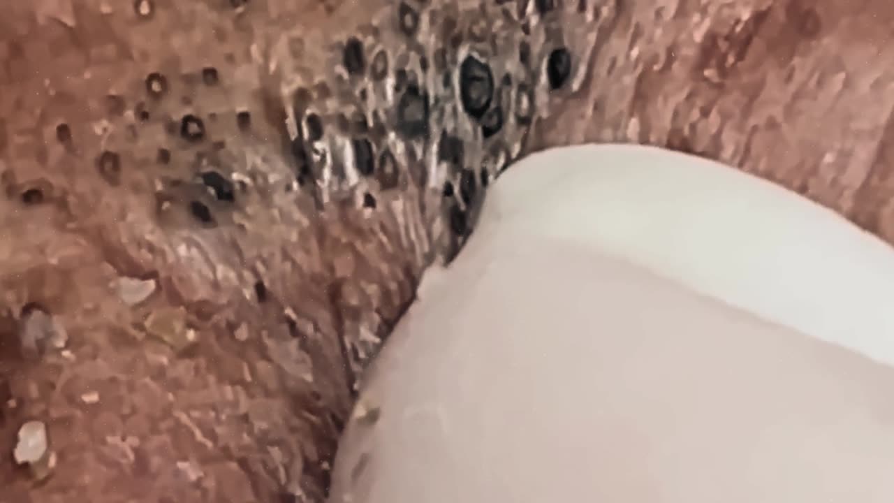 New satisfying blackhead removal #6