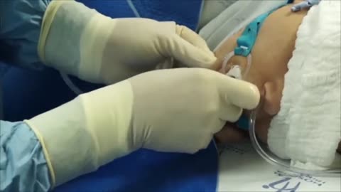 Benefits of Endoscopic Gastric Balloon for Effective Weight Loss