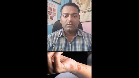 जले हुए शरीर का इलाज ।