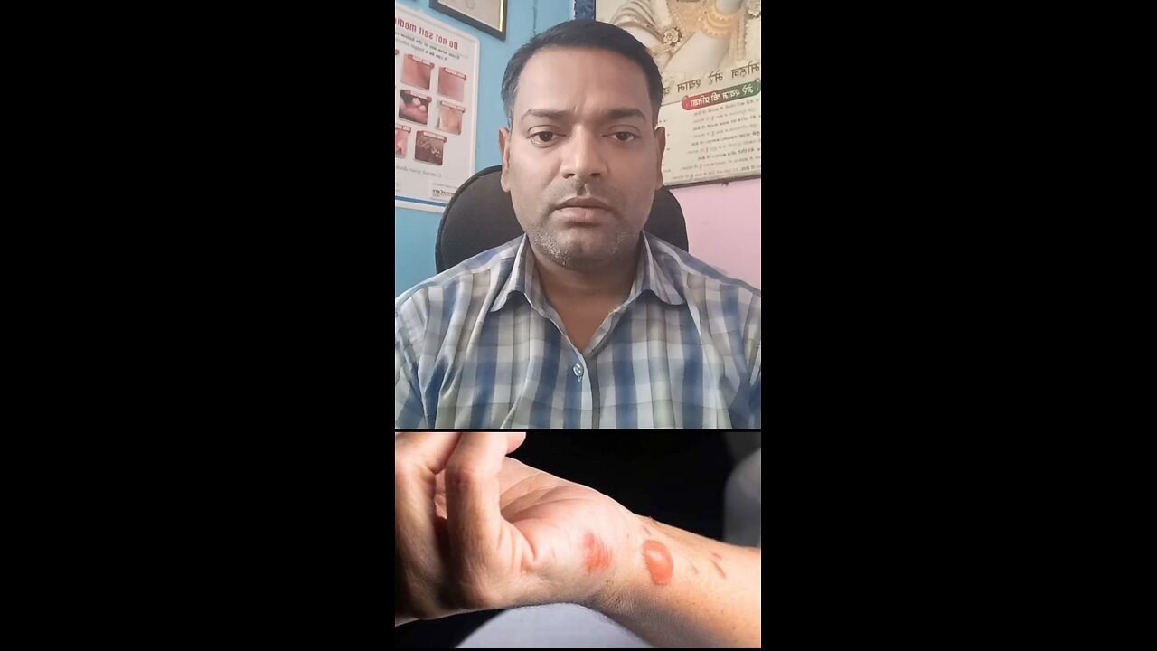 जले हुए शरीर का इलाज ।