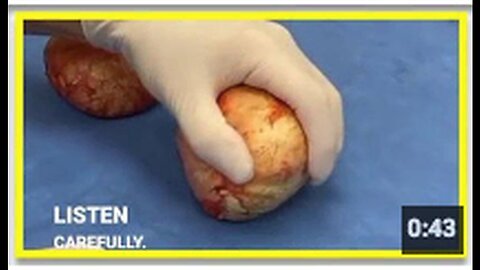 "Hardness in 25-Year-Old Breast Implants"