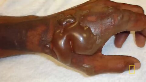 The Skin Gun | National Geographic