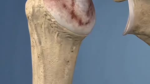 Shoulder Joint Replacement Surgery Explained