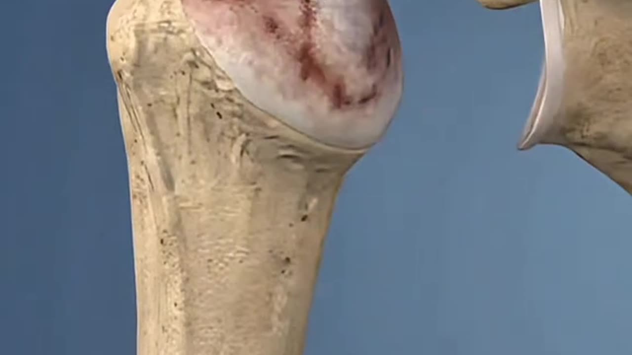 Shoulder Joint Replacement Surgery Explained