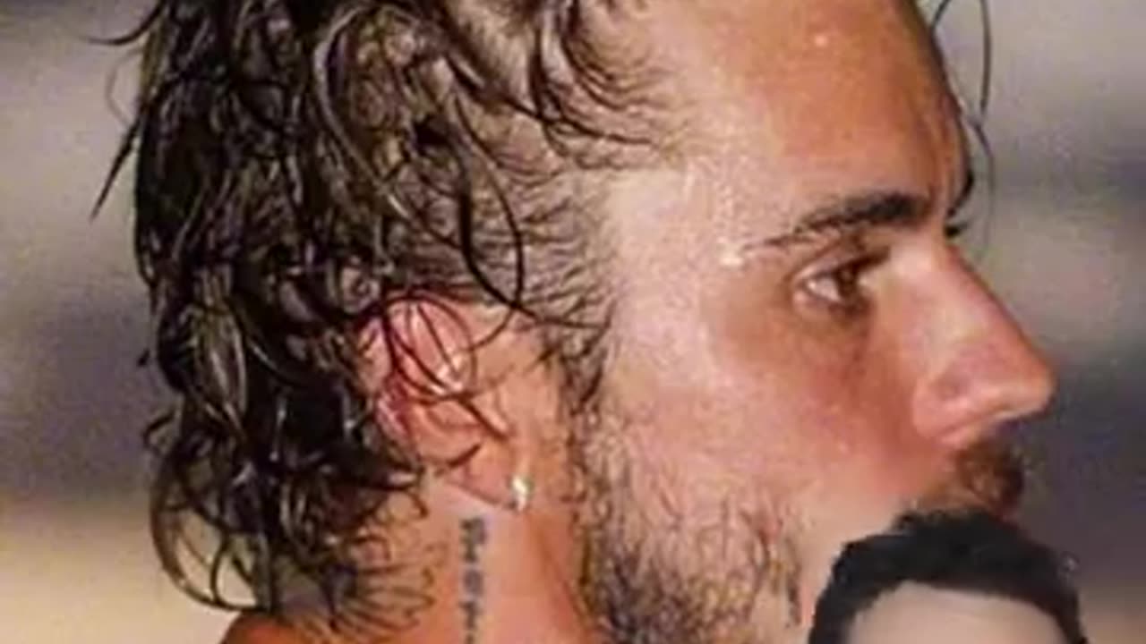 Did Justin Bieber undergo a hair transplant? 🤔