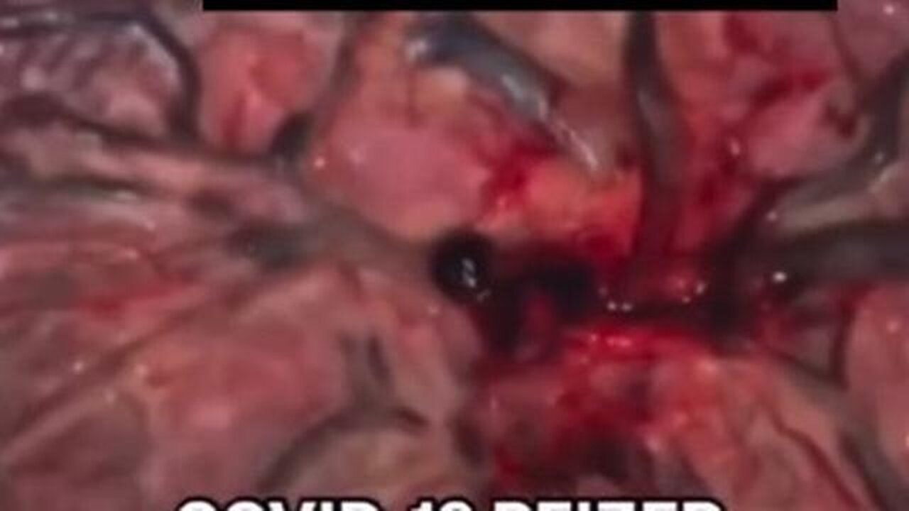 Double Vaccinated Placenta compared to Non-Vaccinated Placenta