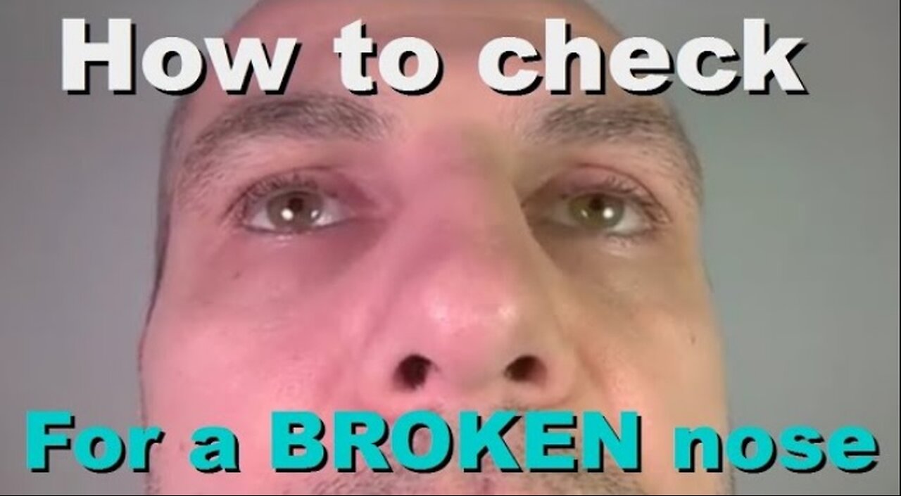 How to check for broken nose - displaced bones accident/impact difficulty breathing