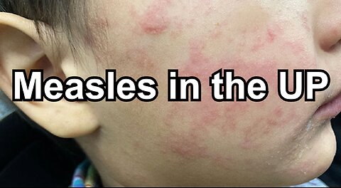 Measles in the UP