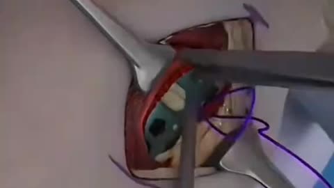 Broken Radius Plating Surgery Explained. Step-by-Step Orthopedic Procedure