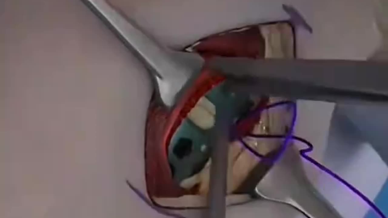 Broken Radius Plating Surgery Explained. Step-by-Step Orthopedic Procedure