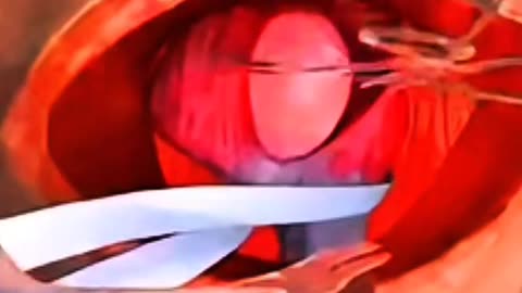 How Surgical Mesh Fixes a Hernia Without Big Cuts — Watch Meshplasty in Action!