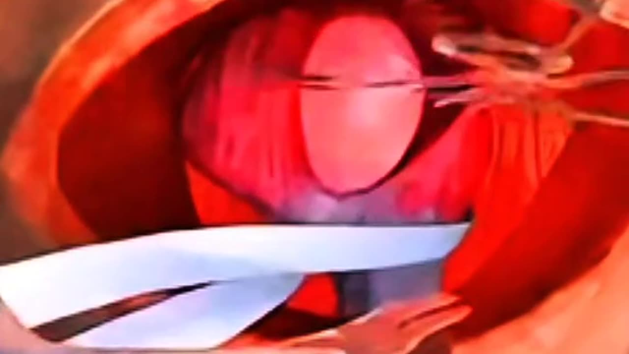 How Surgical Mesh Fixes a Hernia Without Big Cuts — Watch Meshplasty in Action!