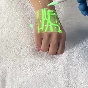 Vein Scanning Tech Revolutionizes Diagnosis with Non-Invasive Blood Flow Imaging