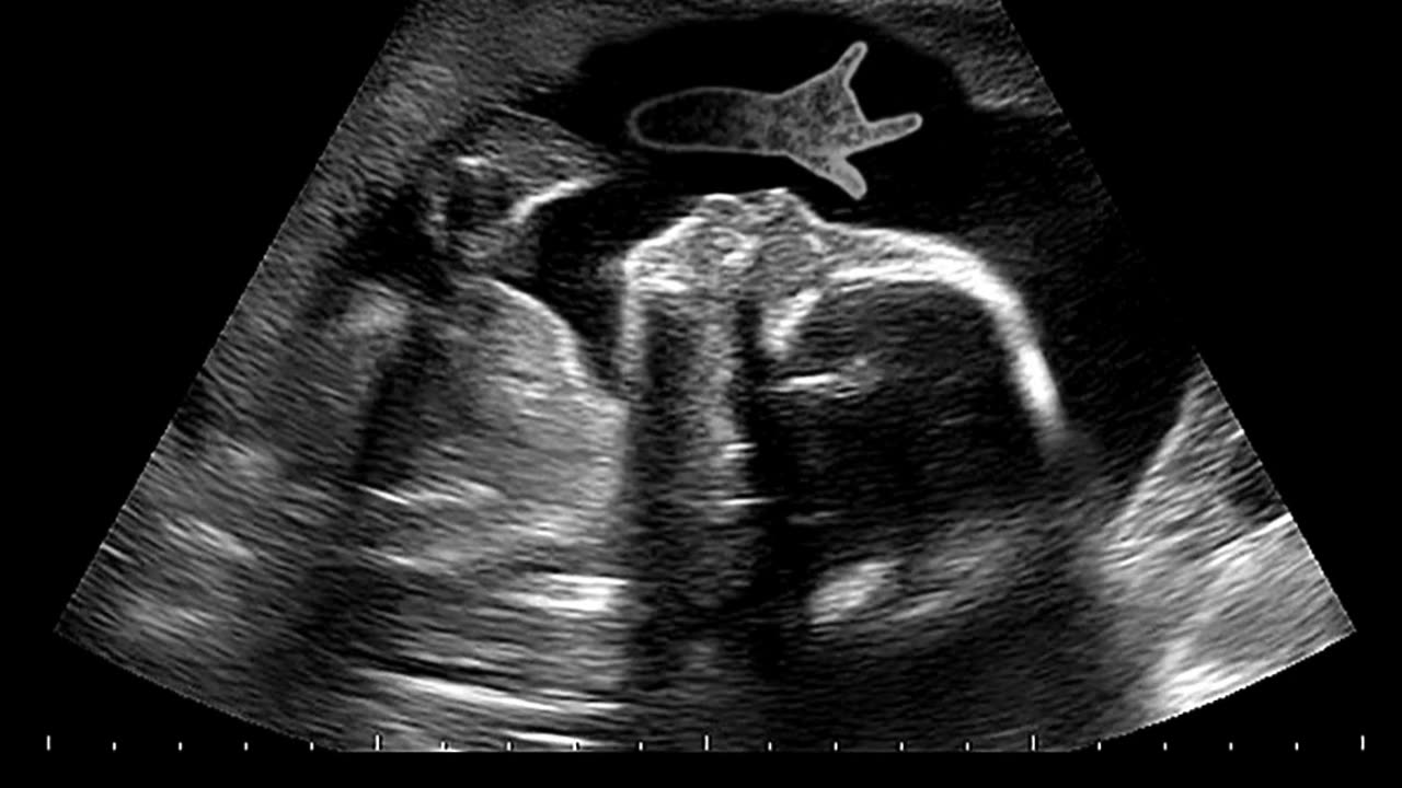 Leading IVF & IUI Fertility Solutions at Sumathi Hospital, Madurai