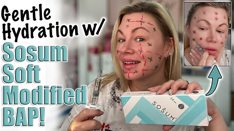Gentle Hydration, Sosum SOft Modified BAP Mesotherapy! AceCosm, code Jessica10 saves you Money