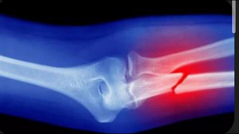 “4 Theories Why You Never Broke a Bone”