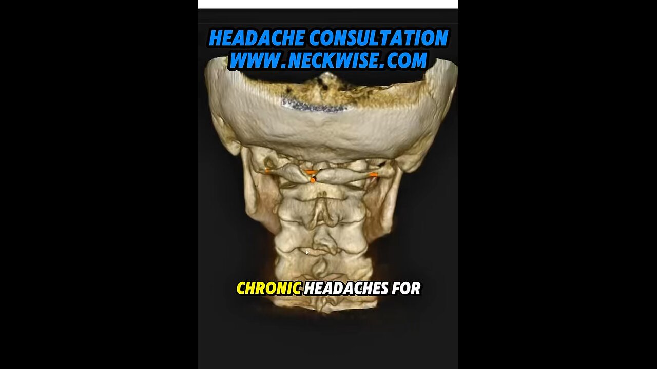 Why whiplash injury can be at root cause of headaches | Neckwise upper cervical chiropractic