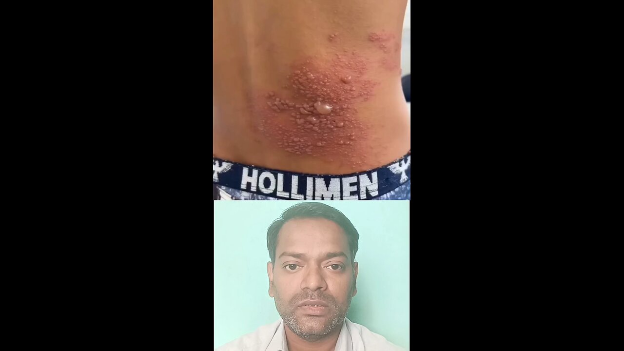 इस बीमारी का नाम ।