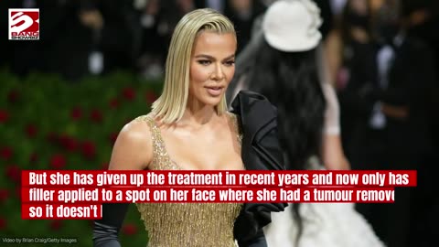 Khloé Kardashian admits looking odd after suffering from 'filler blindness'