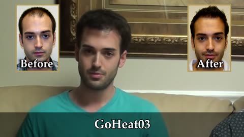 Natural-Looking FUE Hair Transplants in Palm Coast, Florida – Promo