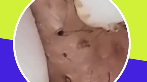 Blackhead removal new this week (ASMR) #5 #shorts