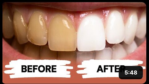 Teeth Whitening at Home