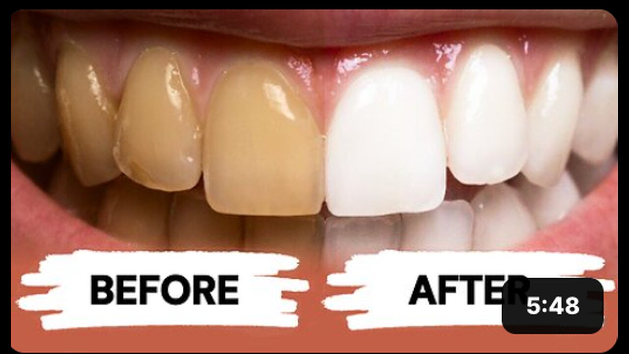 Teeth Whitening at Home