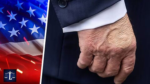 Trump's Medical Swelling Distracts From Epstein Scandal