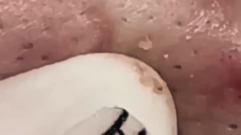 New satisfying blackhead removal (ASMR) #16