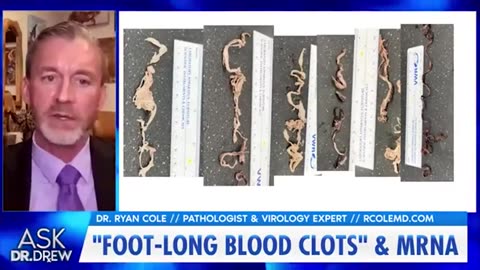 foot long clots removed from mRNA vaccine victims