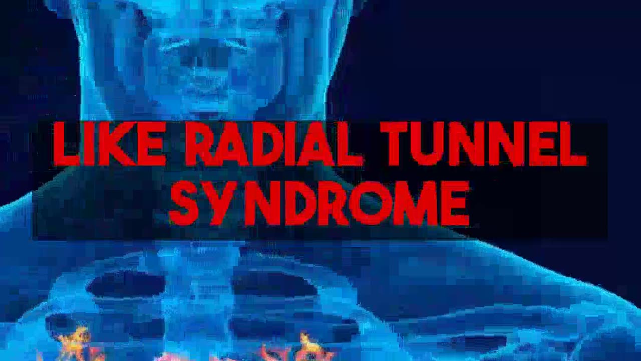 Understanding Radial Tunnel Syndrome AI and New Treatment Pathways