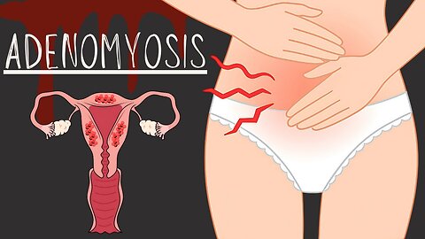 Adenomyosis - Complete Guide You Must Understand (For Physicians & Medical Students) MD43
