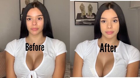 My Breast Augmentation Experience