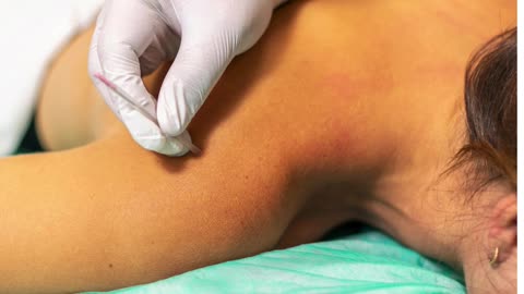 Sri Sai Physiotherapy Clinic: Dry Needling for Fast Muscle Relief!