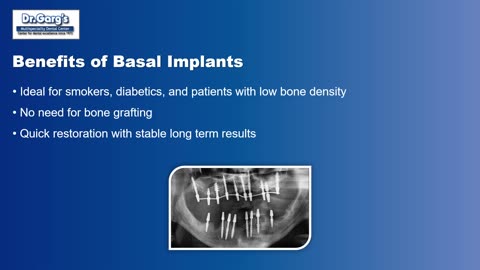 Basal vs Conventional Implants – Clear Guide by Dr. Garg’s Dental Center