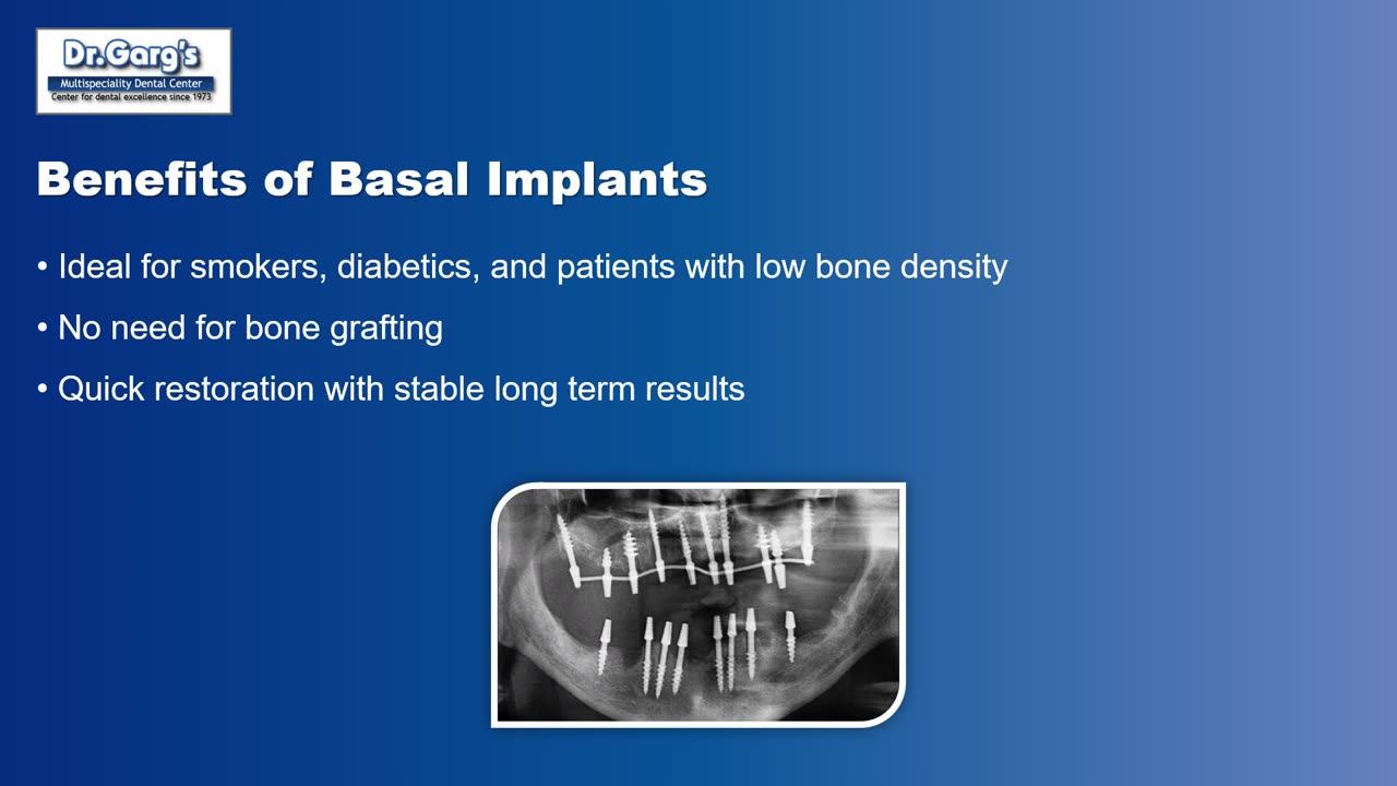 Basal vs Conventional Implants – Clear Guide by Dr. Garg’s Dental Center