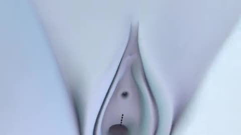 Tension Free Vaginal Tape Procedure 3D Animation (TVT)