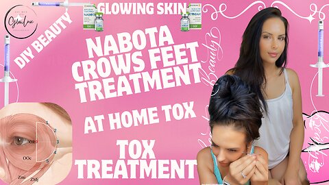 At home CROWS FEET tox with NABOTA 1.1