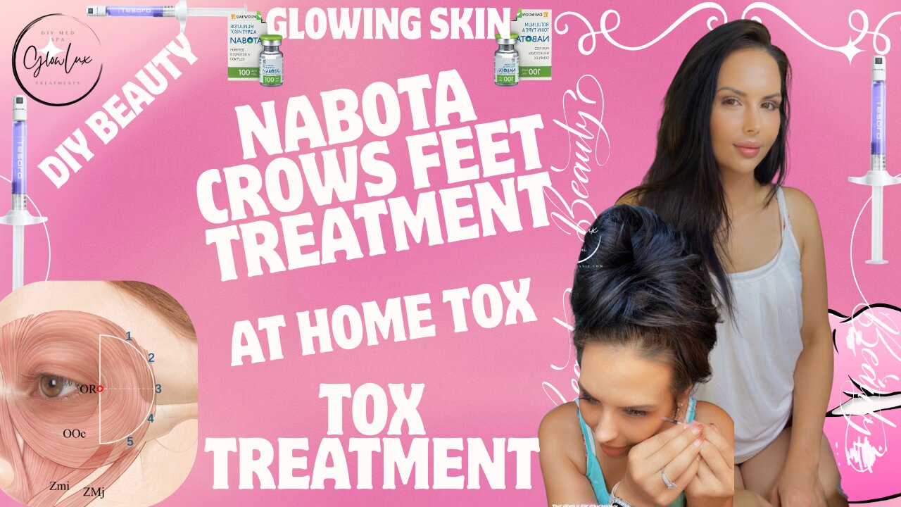 At home CROWS FEET tox with NABOTA 1.1